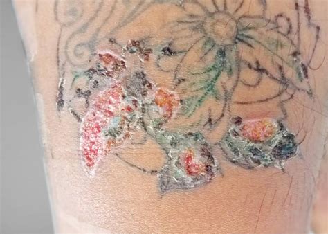 new tattoo leaking ink|Tattoos: 7 unexpected skin reactions and what to do about them